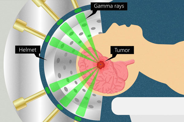 Radiotherapy-For-Brain-Tumor.jpg